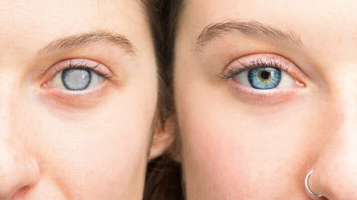 What Is Glaucoma? Signs, Causes, Types, and Care