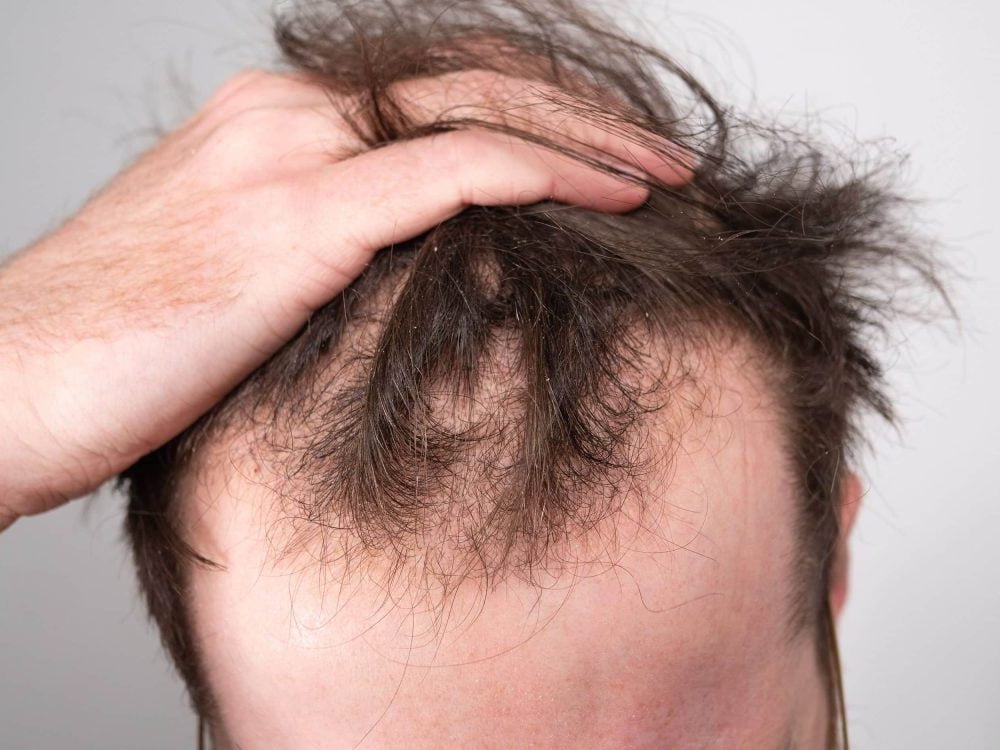 Hair Loss Treatment: Causes, Medications, and Next Steps
