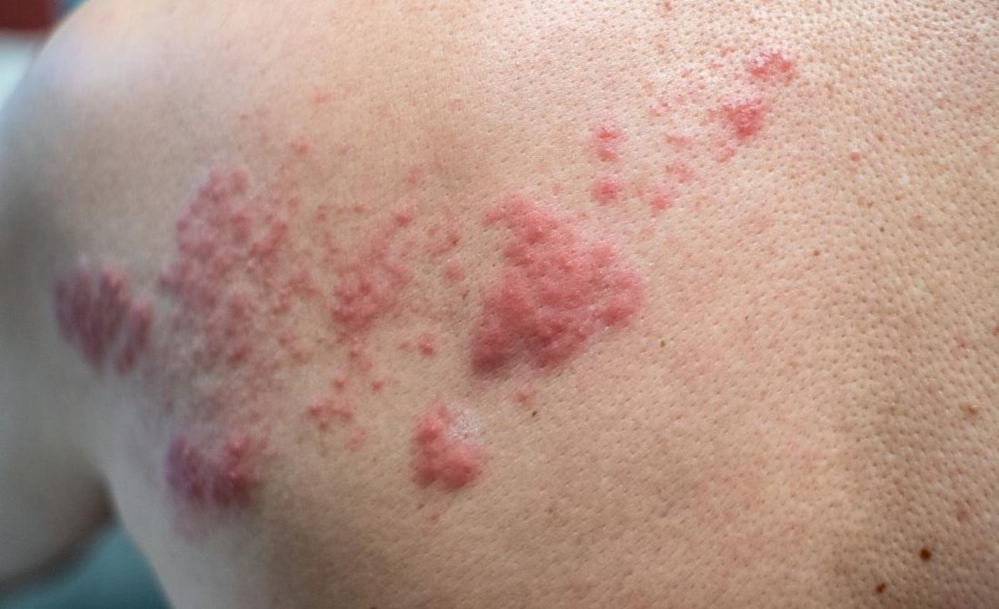 Early Herpes Symptoms, Warning Signs, and Flare Triggers