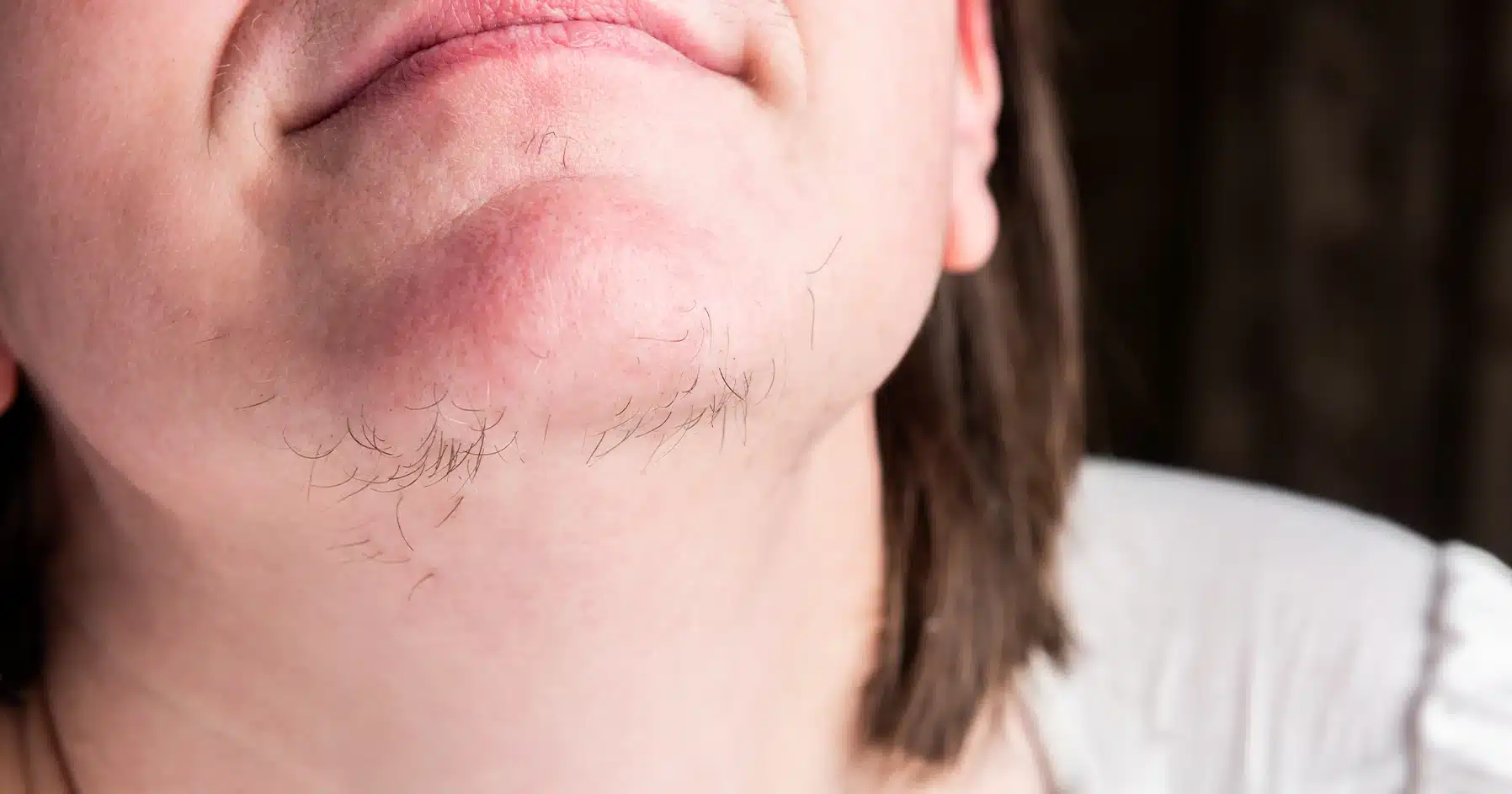 What Is Hirsutism? Causes, Symptoms, and Treatment Options