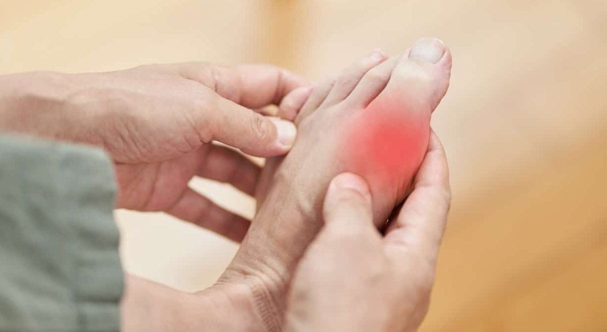 What Is Hyperuricemia? Symptoms, Causes, and Safer Control