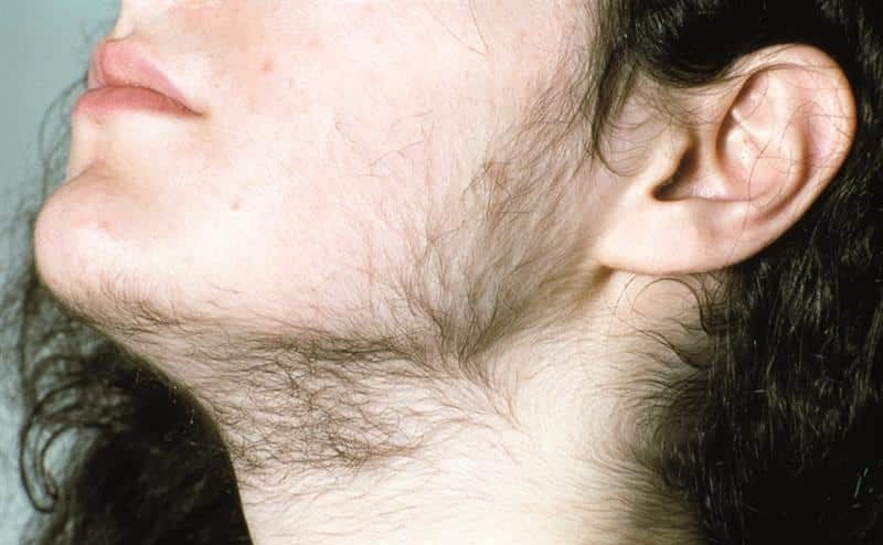 PCOS Symptoms: Signs, Causes, Diagnosis, and Care