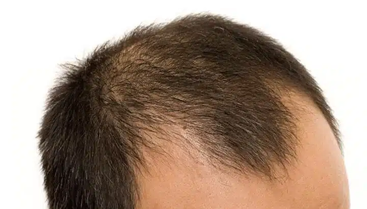 Male Pattern Baldness: Genetics, Stages, and Treatment