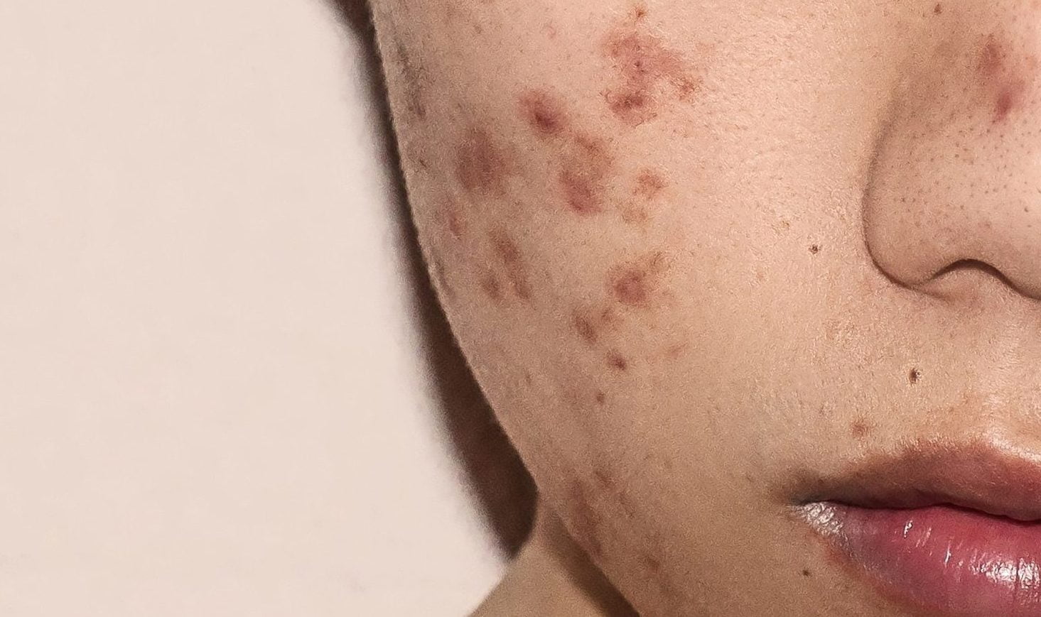 What Is Acne? Symptoms, Causes, and Treatment Options