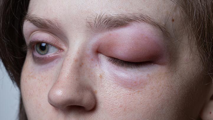 What Is Angioedema? Symptoms, Triggers, And Treatment