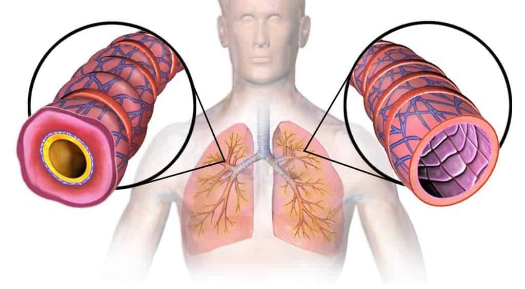 Asthma Triggers: Causes, Cough Clues, and Home Control