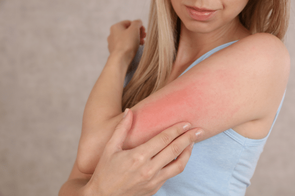 Clobetasol Propionate Side Effects and Safer Use