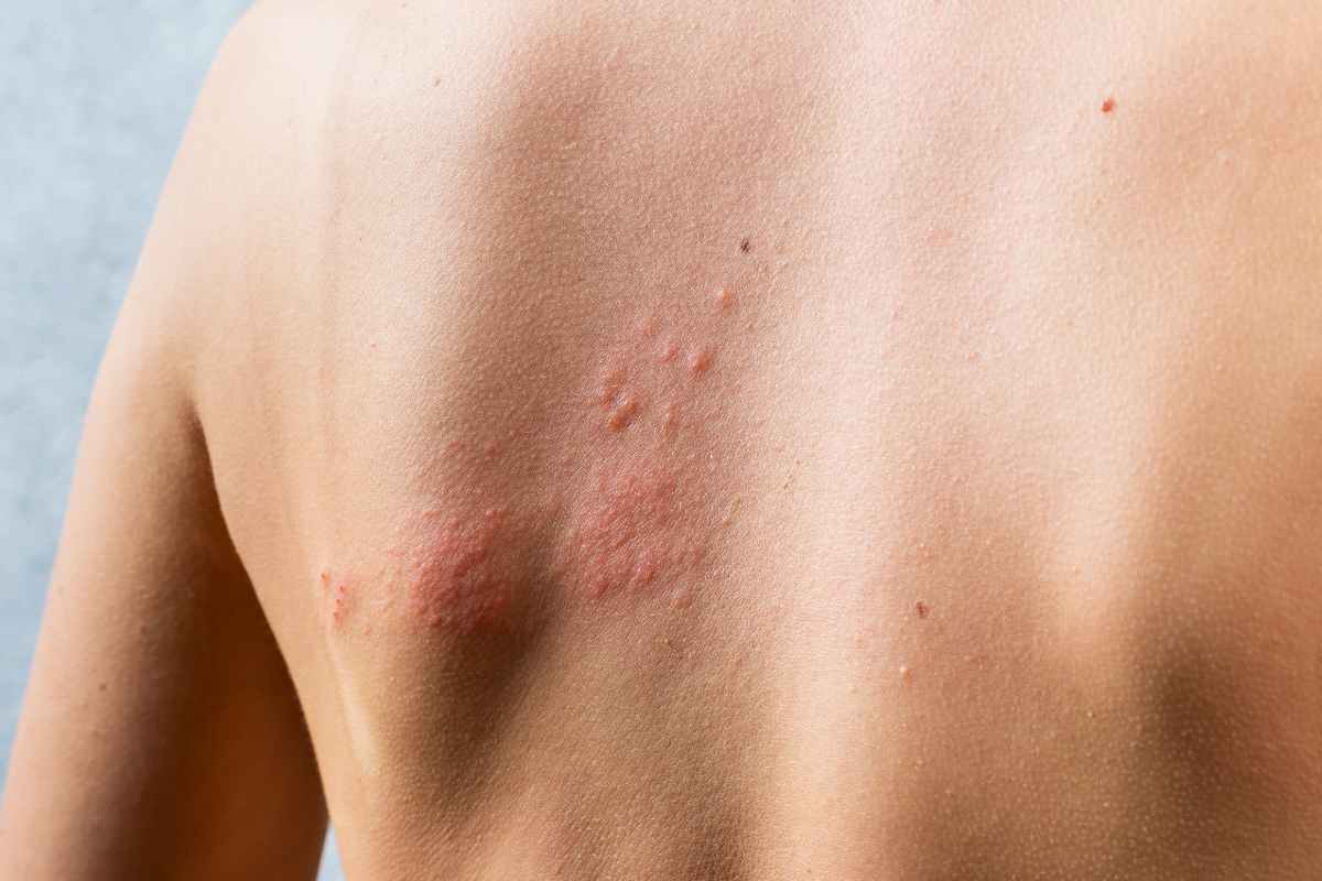 Porphyria Cutanea Tarda Treatment and Long-Term Management