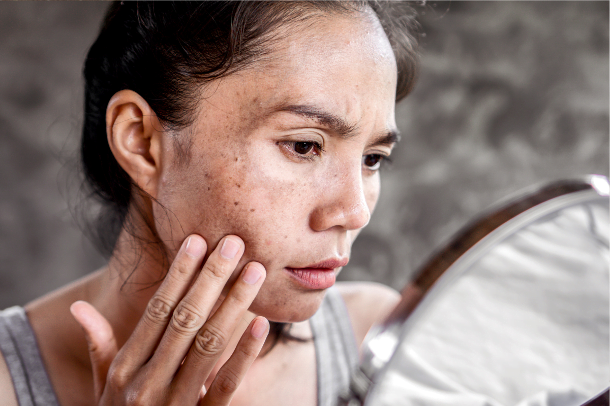Cosmetic Camouflage for Hyperpigmentation: Safe Coverage Steps