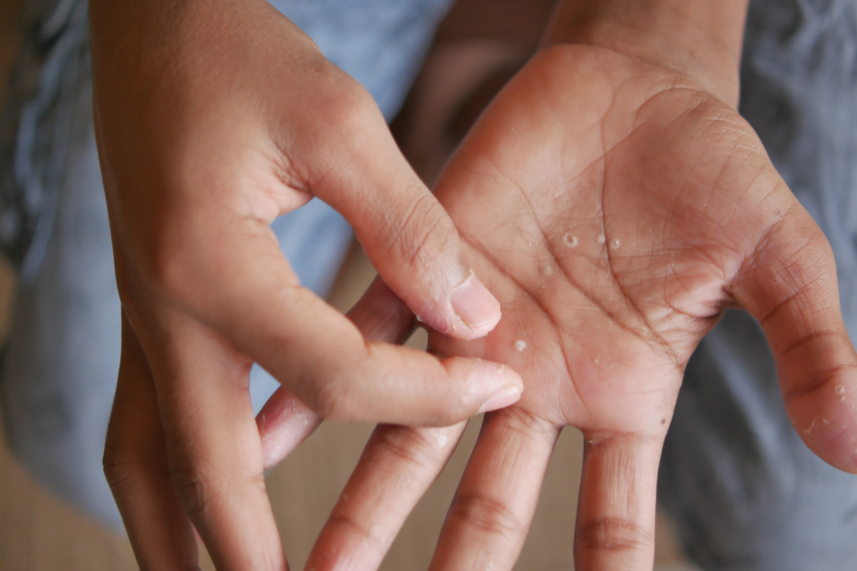 Stress Dyshidrotic Eczema: Role, Triggers, and Contagious Risk