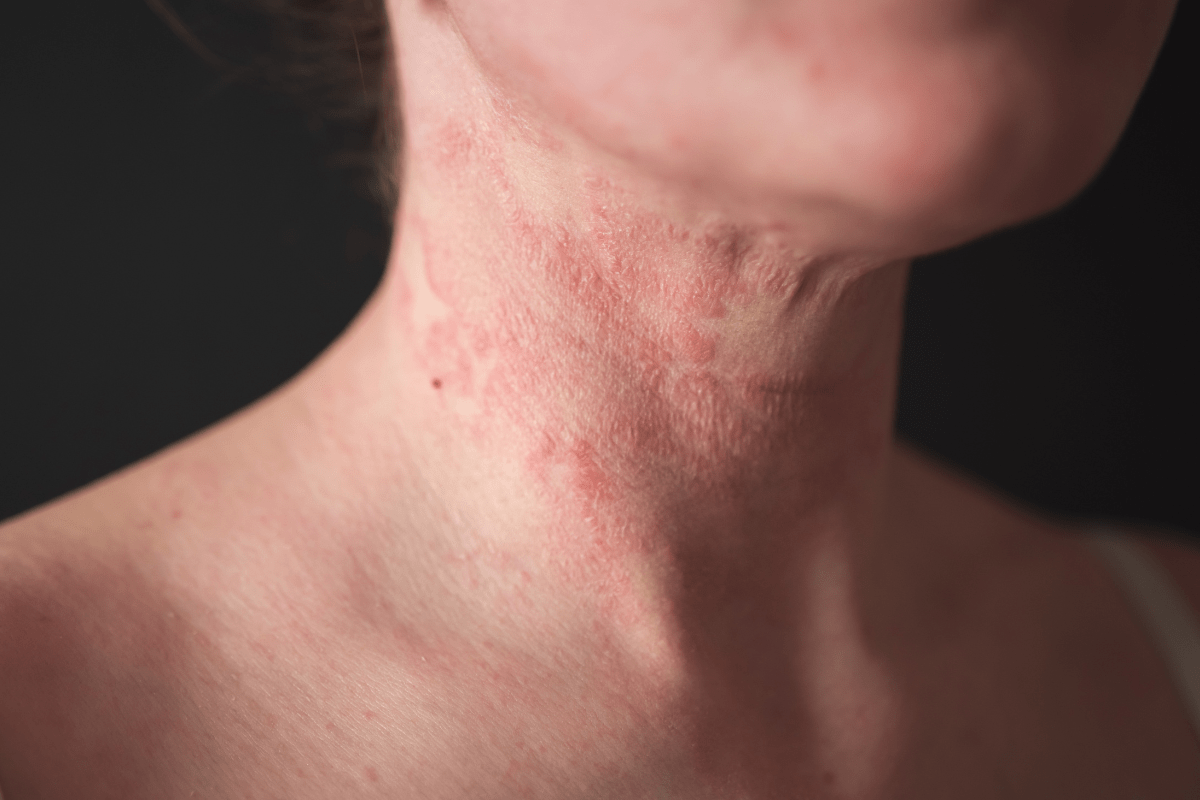 Dyshidrotic Eczema and Autoimmune Disease: Symptoms and Care