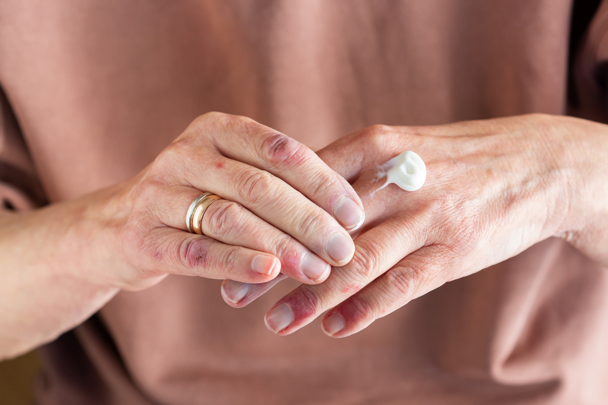 Palmoplantar Pustulosis vs Dyshidrotic Eczema: Key Differences
