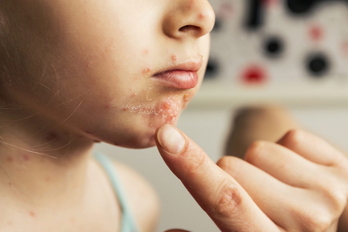 Chickenpox vs Shingles: Symptoms, Rash, and Contagion