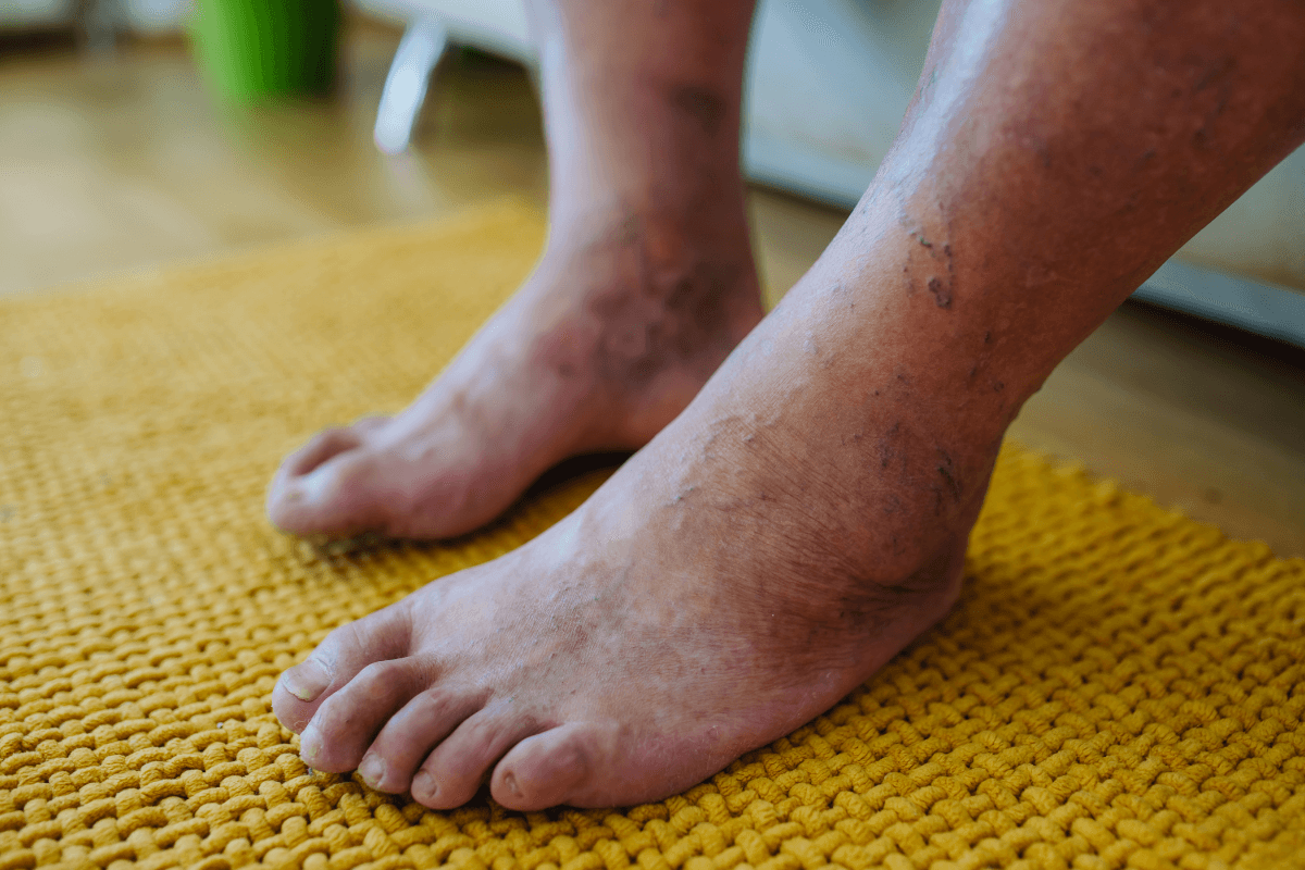 Diabetic Foot Ulcers: Warning Signs, Causes, and Early Care