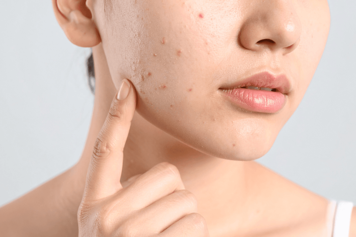 Doxycycline Hyclate for Acne: Expectations and Questions